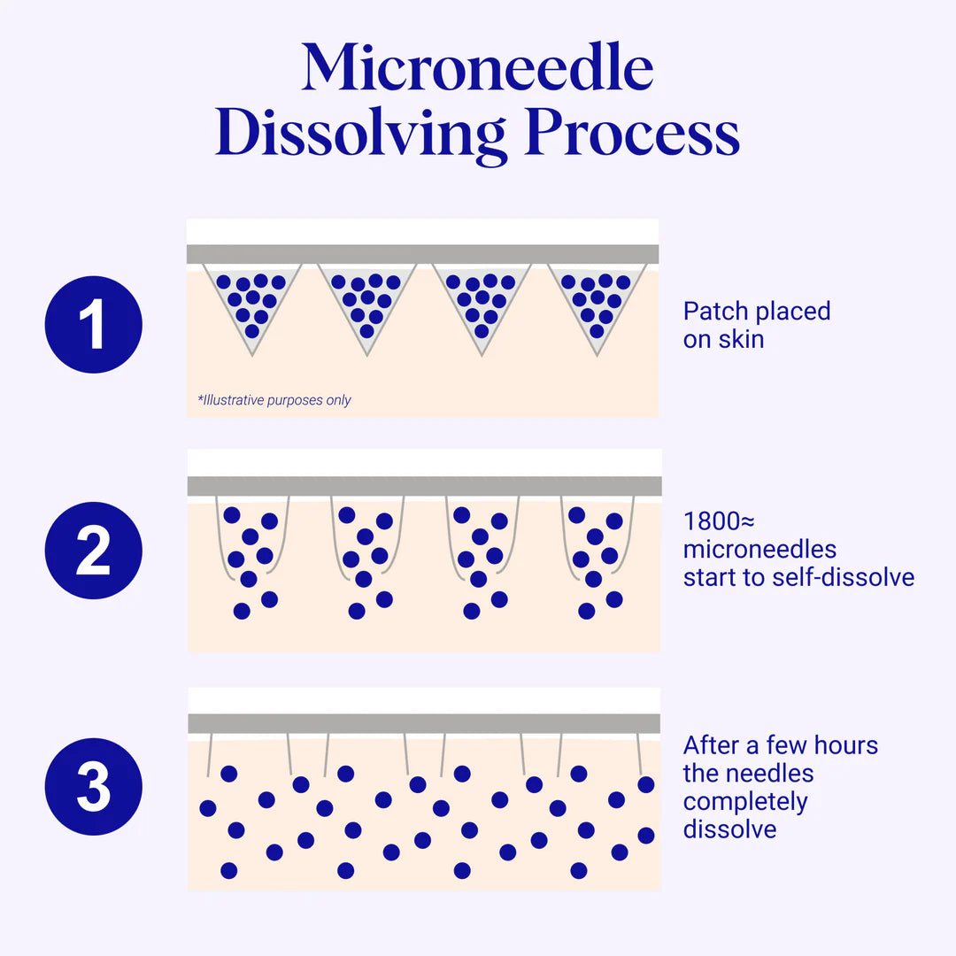 Self-Dissolving Microneedle Patches